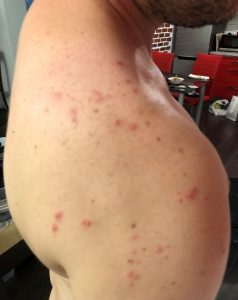 Bed Bug Bites - Shoulder