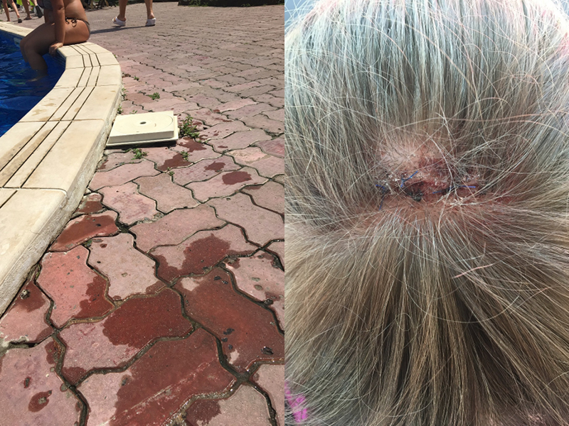 hotel trip by pool head injury