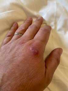 An image of a bed bug injury - a hand that has been bitten by a bed bug.