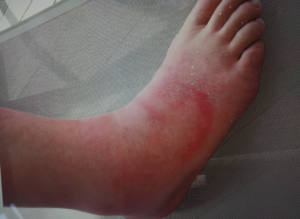 An ankle injury due to an aeroplane accident on holiday