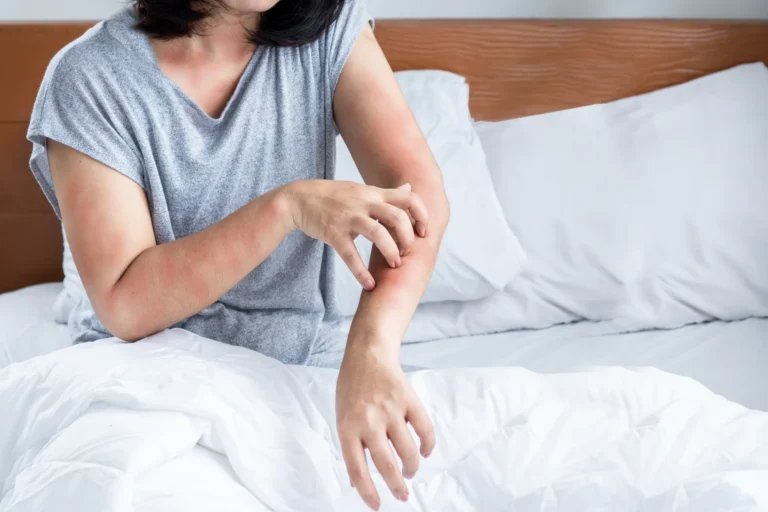 Covent Garden Guest Awarded £2,055 After Waking Up Covered in Bed Bug Bites