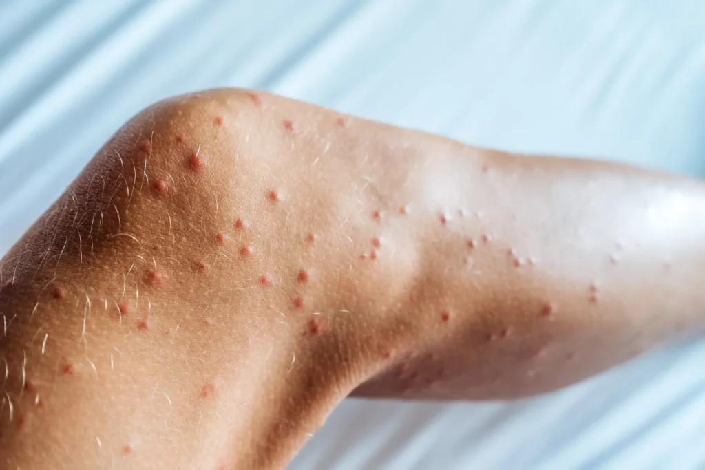 Holiday Inn Express Bed Bug Claim Victims Receives £3,000 Compensation