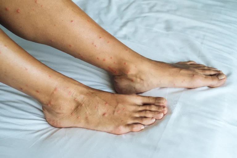 UK Bed Bug Crisis – What UK Holidaymakers Need to Know